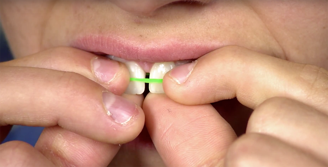 Rubber band on gapped front teeth. Photo from a public service video by American Association of Orthodontists