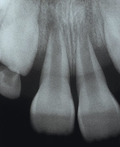 X-ray of teeth roots damaged by gap bands, requiring extensive oral surgery. Photo from American Journal of Orthodontics and Dentofacial Orthopedics
