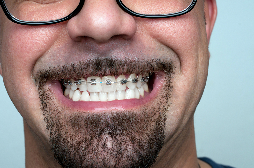 Young man with braces. Getty Image